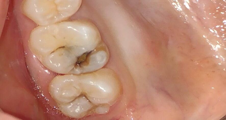 Esthetic tooth colored (composite) filling