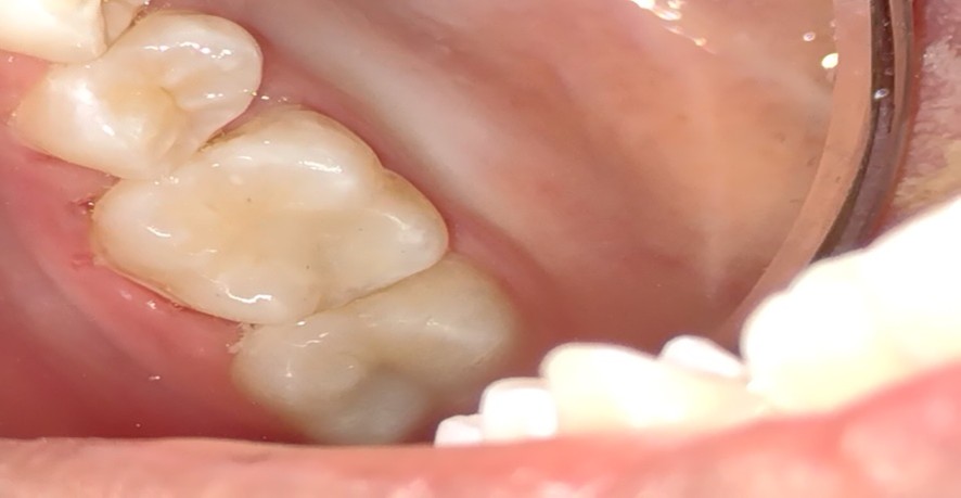 Esthetic tooth colored (composite) filling