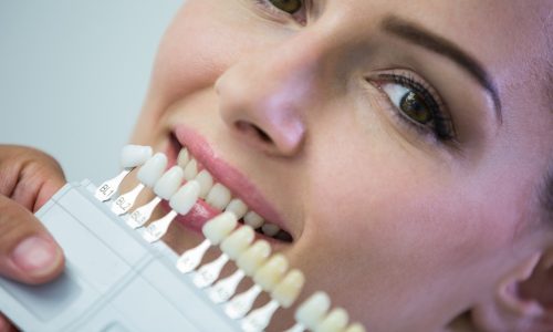 Esthetic Tooth-Colored (Composite) Fillings