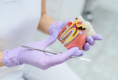Root Canal Treatment Under Magnification